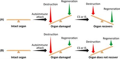 Autoimmune diseases refractory to corticosteroids and immunosuppressants